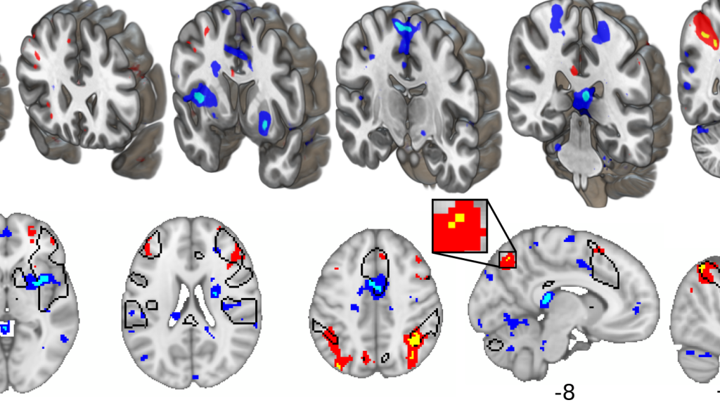 fMRI activity during pain is reduced in the areas shown in blue. Many of these are involved in constructing the experience of pain. Activity is increased in the areas shown in red and yellow, which involve the control of cognition and memory. (Image provi